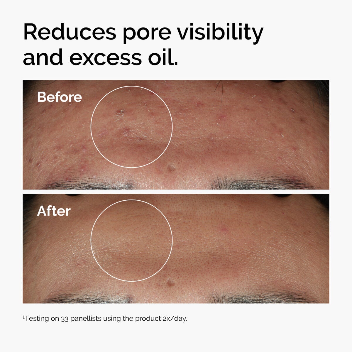 niacinamide-10-zinc-1-m4 ord-niacinamide-zinc-blemish-serum-before-after-pores.jpg