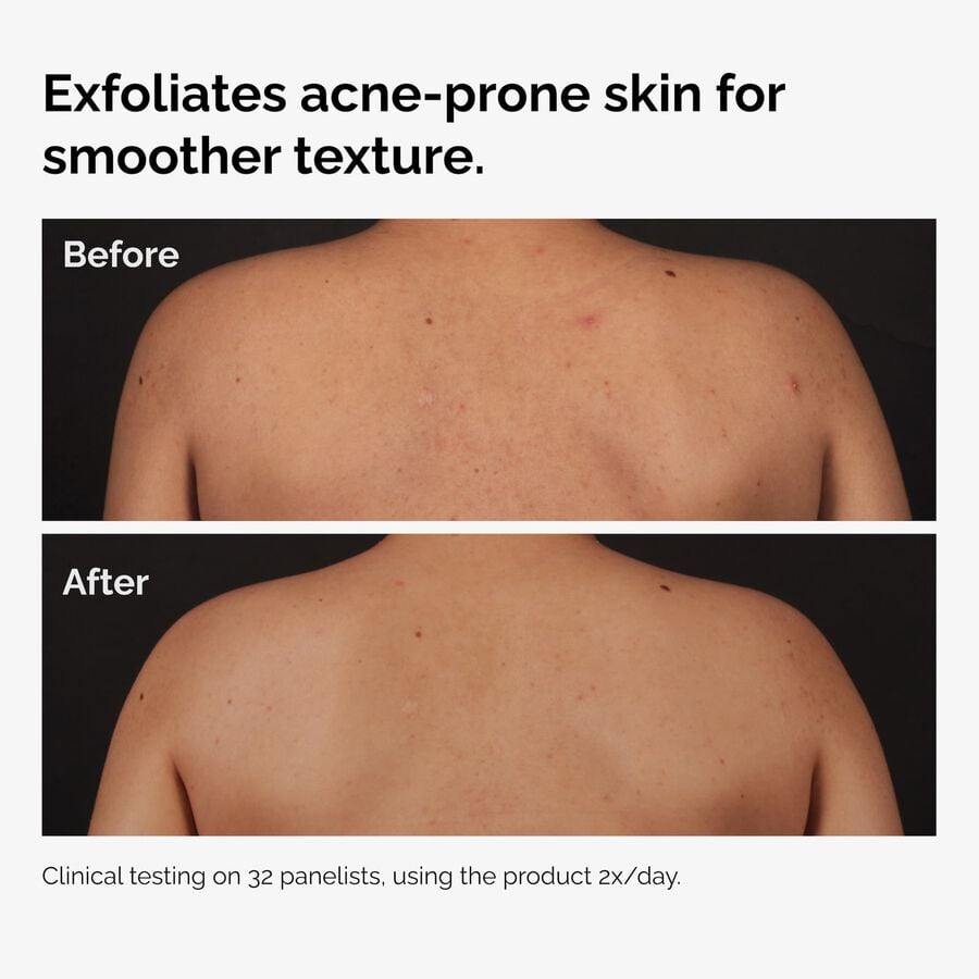 the-body-care-collection-y2 ord-salicylic-acid-body-serum-before-after-graphic-NA.jpg