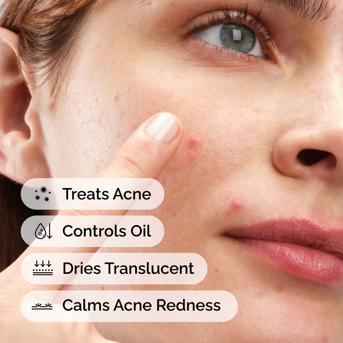 sulfur-10-powder-to-cream-concentrate-f8 ord-sulfur-10pct-powder-to-cream-concentrate-model-application-with-benefits-acne.jpg