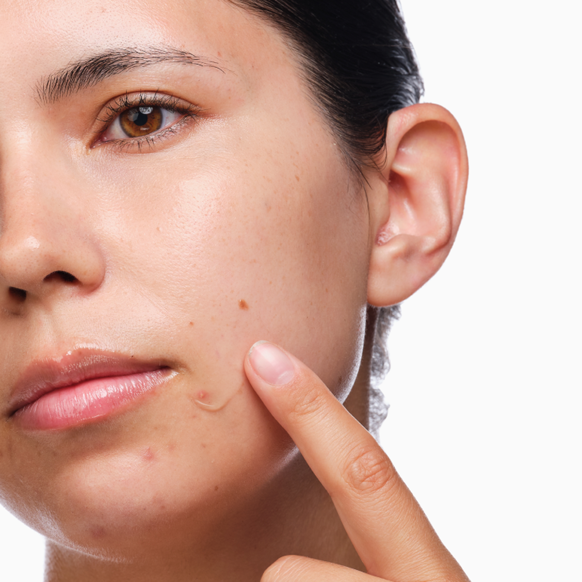 the-acne-set-c5 rdn-the-acne-set-application.png